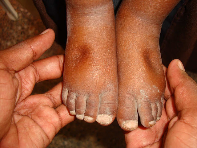 Hati-hati Jika Anda Mempunyai Kesan Lekuk Seperti Ini Di Kaki Hati-hati Jika Anda Mempunyai Kesan Lekuk Seperti Ini Di Kaki