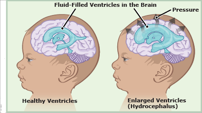 My Family Medicine Practice: Introduction to Hydrocephalus