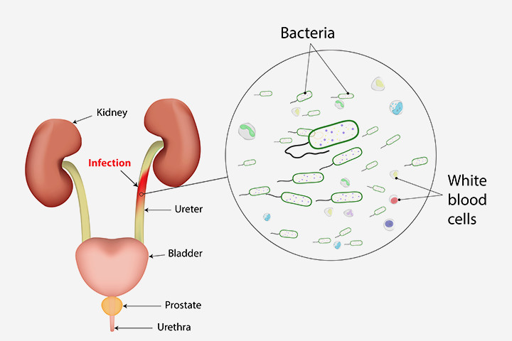 infeccion urinaria sintomas tratamiento