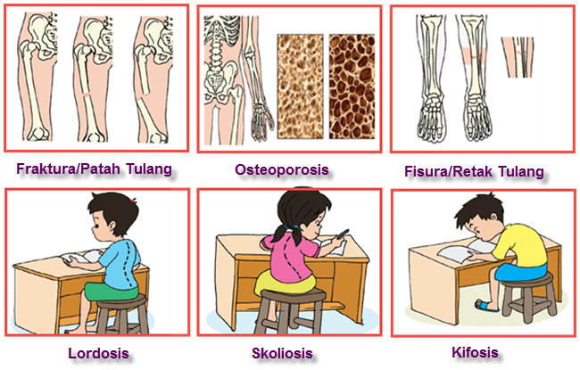 Macam macam Kelainan pada  Organ  Gerak  Pasif Tulang 