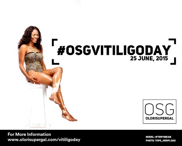 It's World Vitiligo day,an event for awareness of the Skin Condition. io