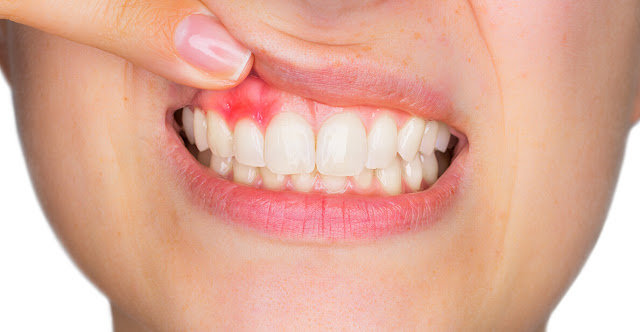 Tooth Abscess Home Remedy Tooth Abscess Home Remedy