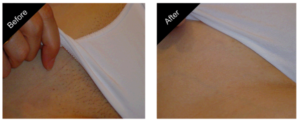 Free Online Sex Therapy Bikini Line Laser