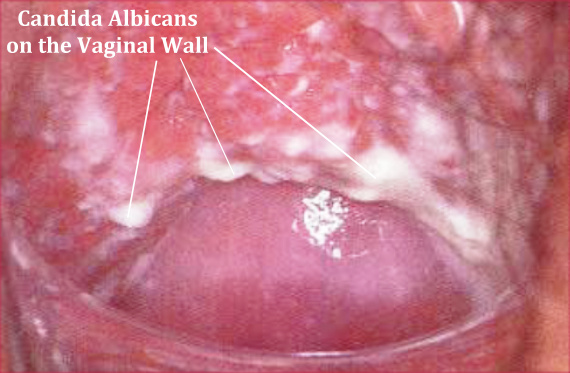 Image result for candidiasis vagina