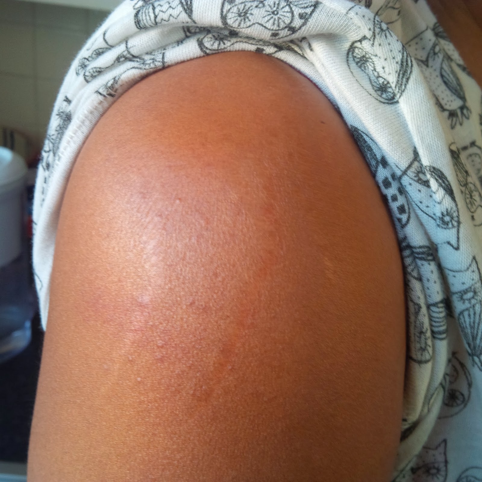 apothederm stretch mark cream