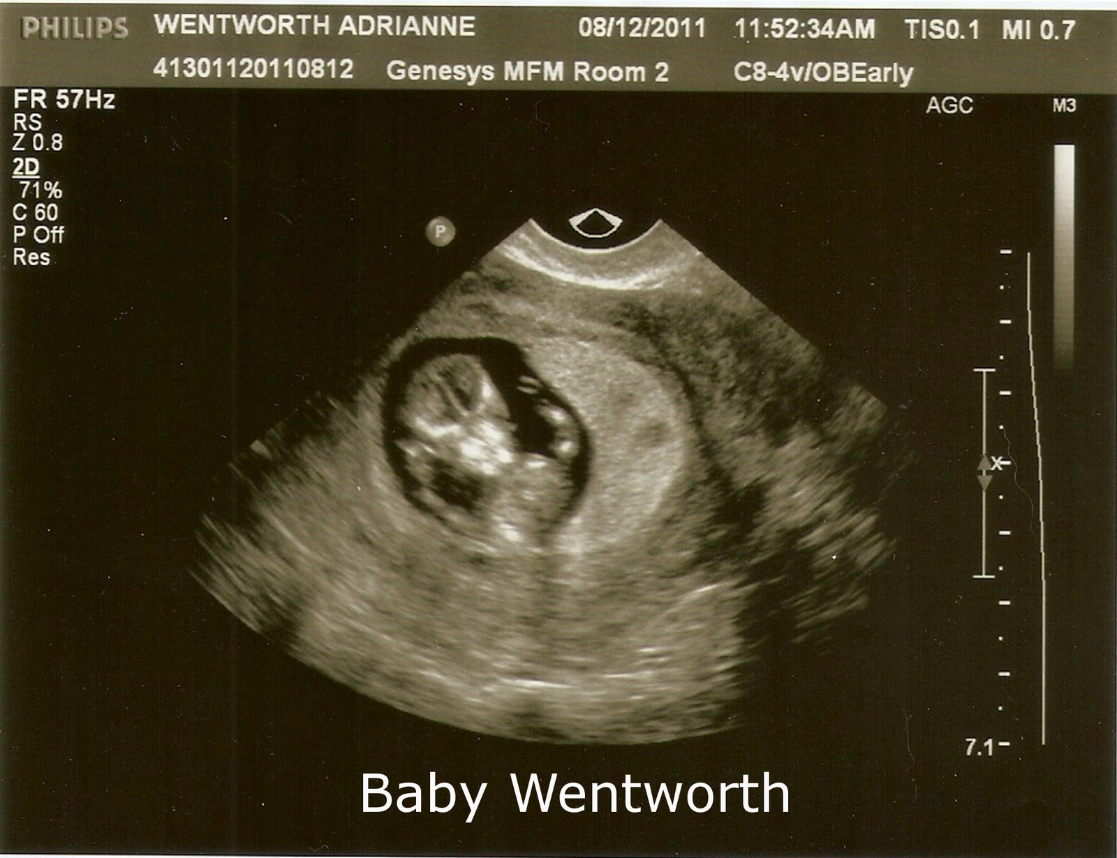 Your 10 Week Ultrasound Pics: What You’re Actually Looking At