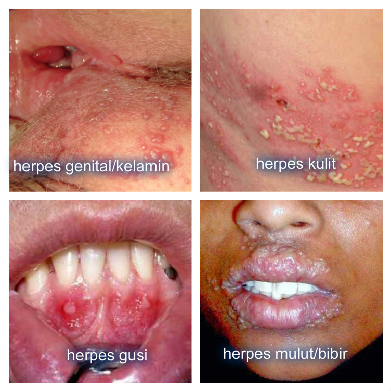 https://2.bp.blogspot.com/-1YvFAh7EeX0/WQGxB1j5chI/AAAAAAAAAdc/nO8jMDsB-doryxUu_4UGpNl3Cd_nqMSCgCLcB/s1600/Ciri-Ciri-Penyakit-Herpes.jpg