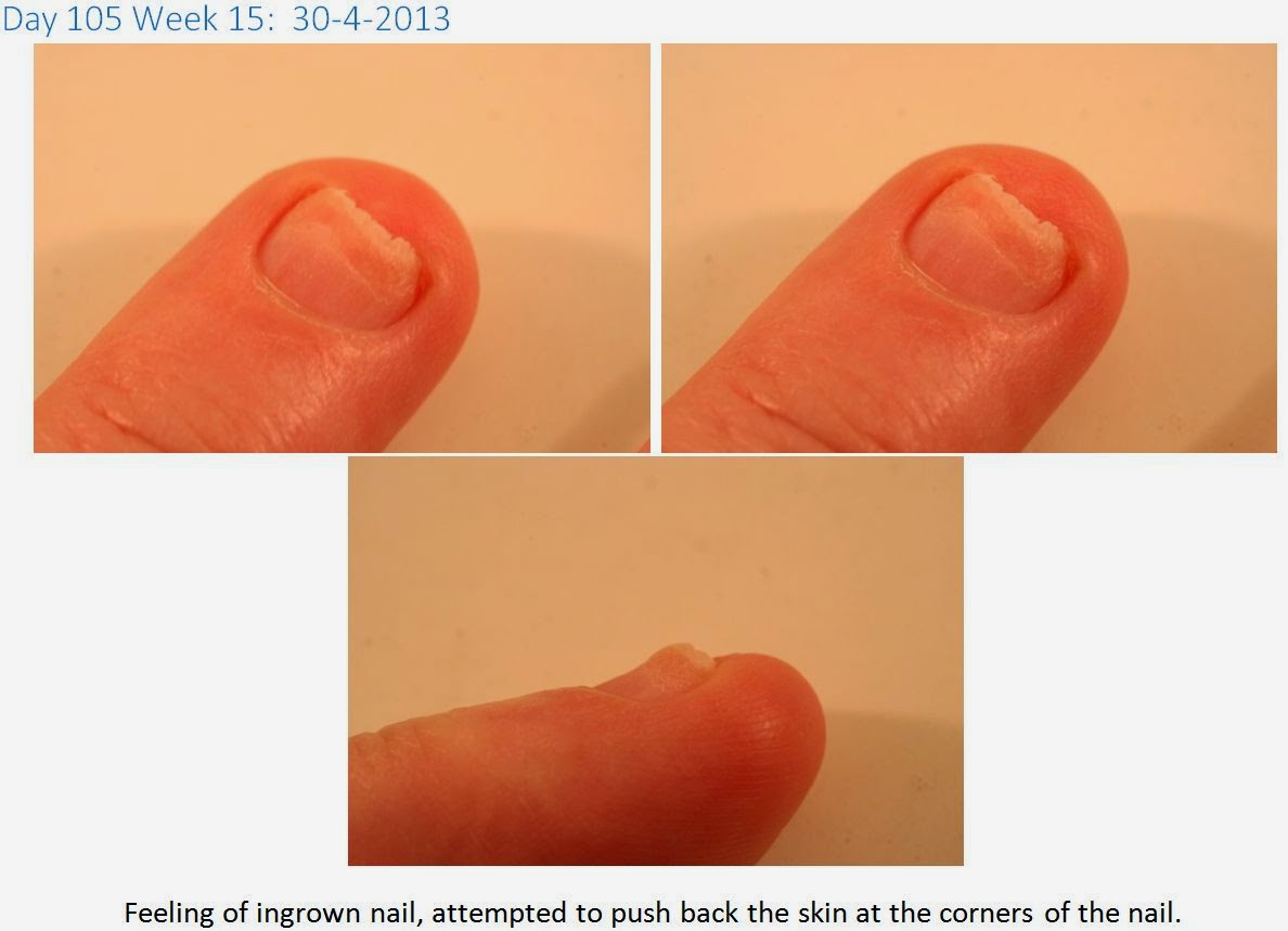 Personal Touch Works Recovery from a ripped off finger nail