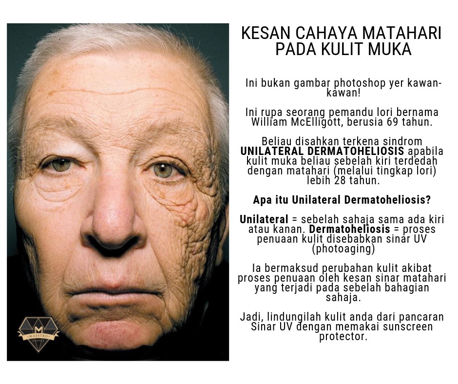 Kesan Tidur Lewat Pada Kulit Muka