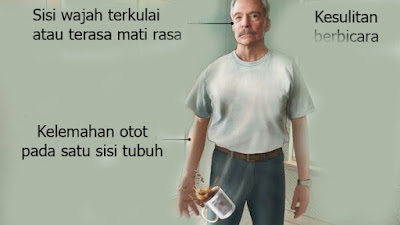 Kenali Penyakit Stroke,Gejala Stroke,Dan Cara Mencegah Stroke Kenali Penyakit Stroke,Gejala Stroke,Dan Cara Mencegah Stroke