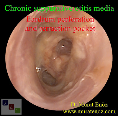 tympanic membrane perforation - retraction pocket - chronic suppurative otitis media