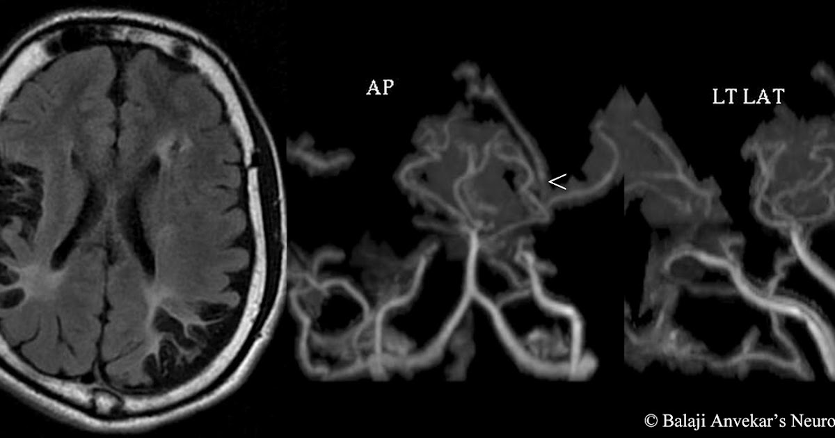 Neuroradiology cases moyamoya disease mri