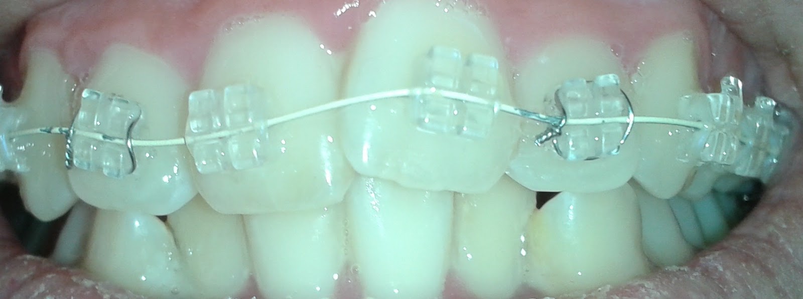 Mi ortodoncia paso a paso y más febrero 2012