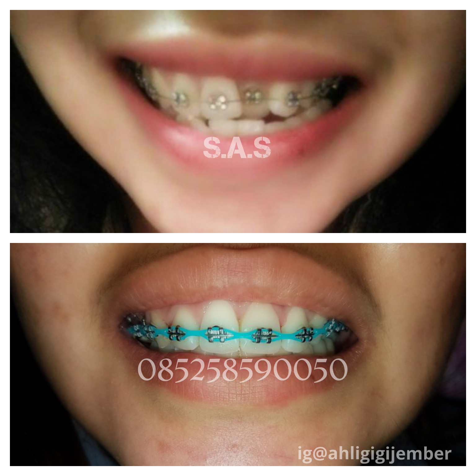 Warna Behel Yang Cocok Untuk Kulit Sawo Matang Pintar Mencocokan