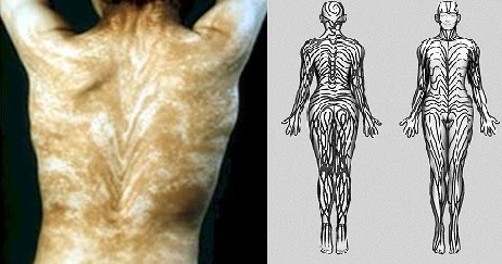 ¿Qué son las líneas de Blaschko? El Médico Contesta