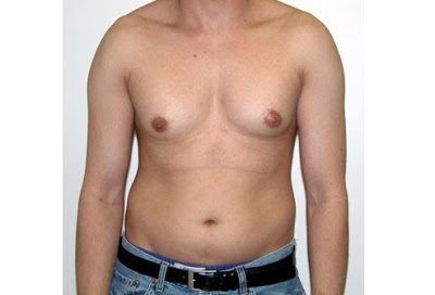 Gynecomastia in liver cirrhosis