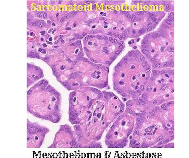 Sarcomatoid Mesothelioma