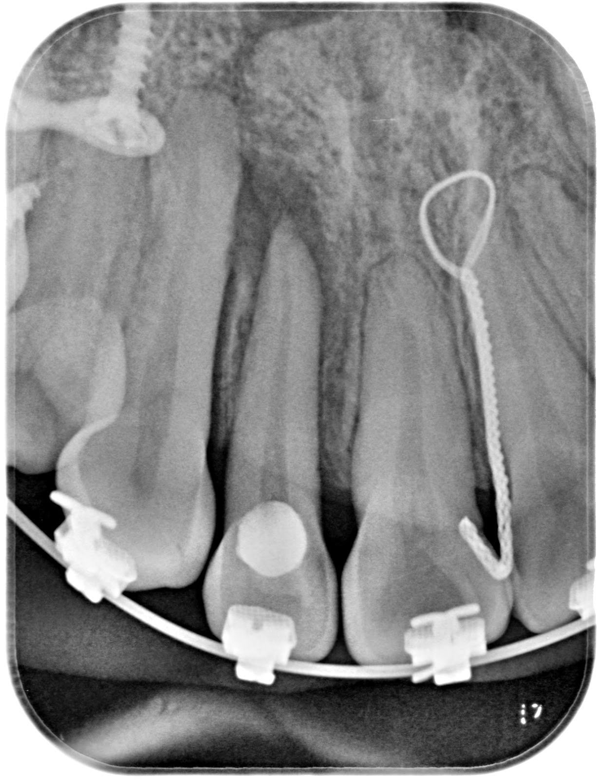 endodonciamississippi Endodoncia 12 con periodontitis apical cronica