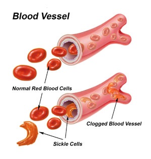 sickle cell anemia disease blood cells red diseases shaped trait crescent garcia anna death health
