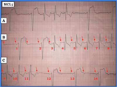 ECG Interpretation: ECG Blog #130 (AV Block – ABBB – RBBB – LBBB)