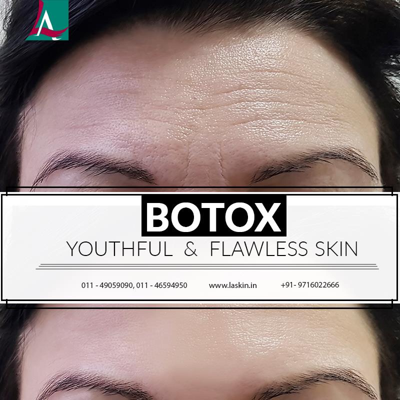 Botox Treatment in Defence Colony