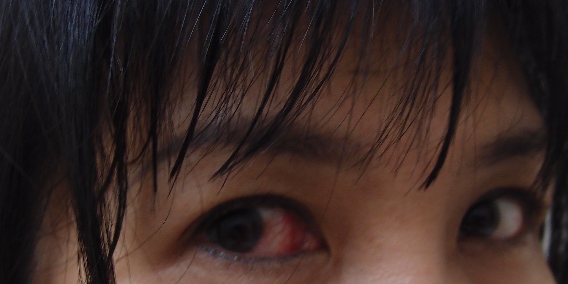 Xing Fu BLOODSHOT EYES AFTER MIGRAINE ATTACK