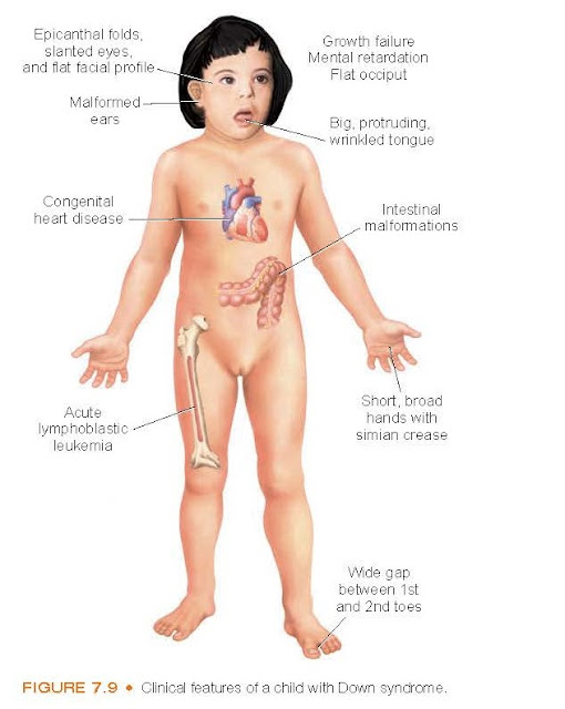 Clinical features of a child with Down syndrome.