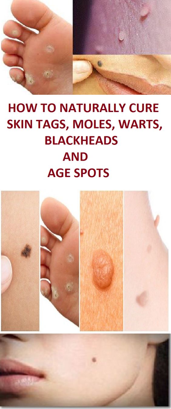 How To Naturally Cure Skin Tags, Moles, Warts, Blackheads, And Age Spots