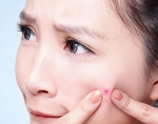 nguyên nhân gây mụn điều trị mụn