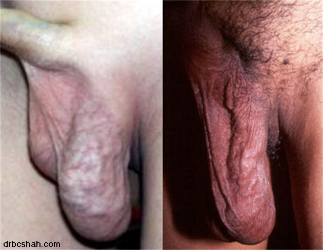 Large Veins On Penis 15