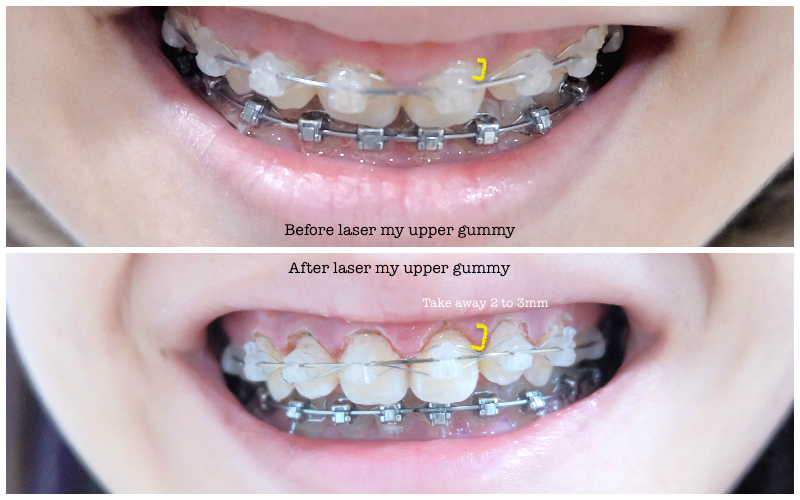 MY BRACES STORY 5 Laser Gum & Changes Travel & Beauty