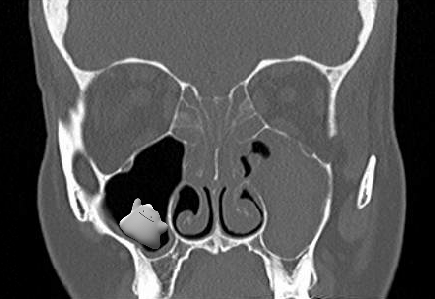Local ENT Surgeon Missed Rare Sinus Pathology on CT Scan Fauquier ENT