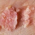 Obat Hpv Tradisional thumbnail