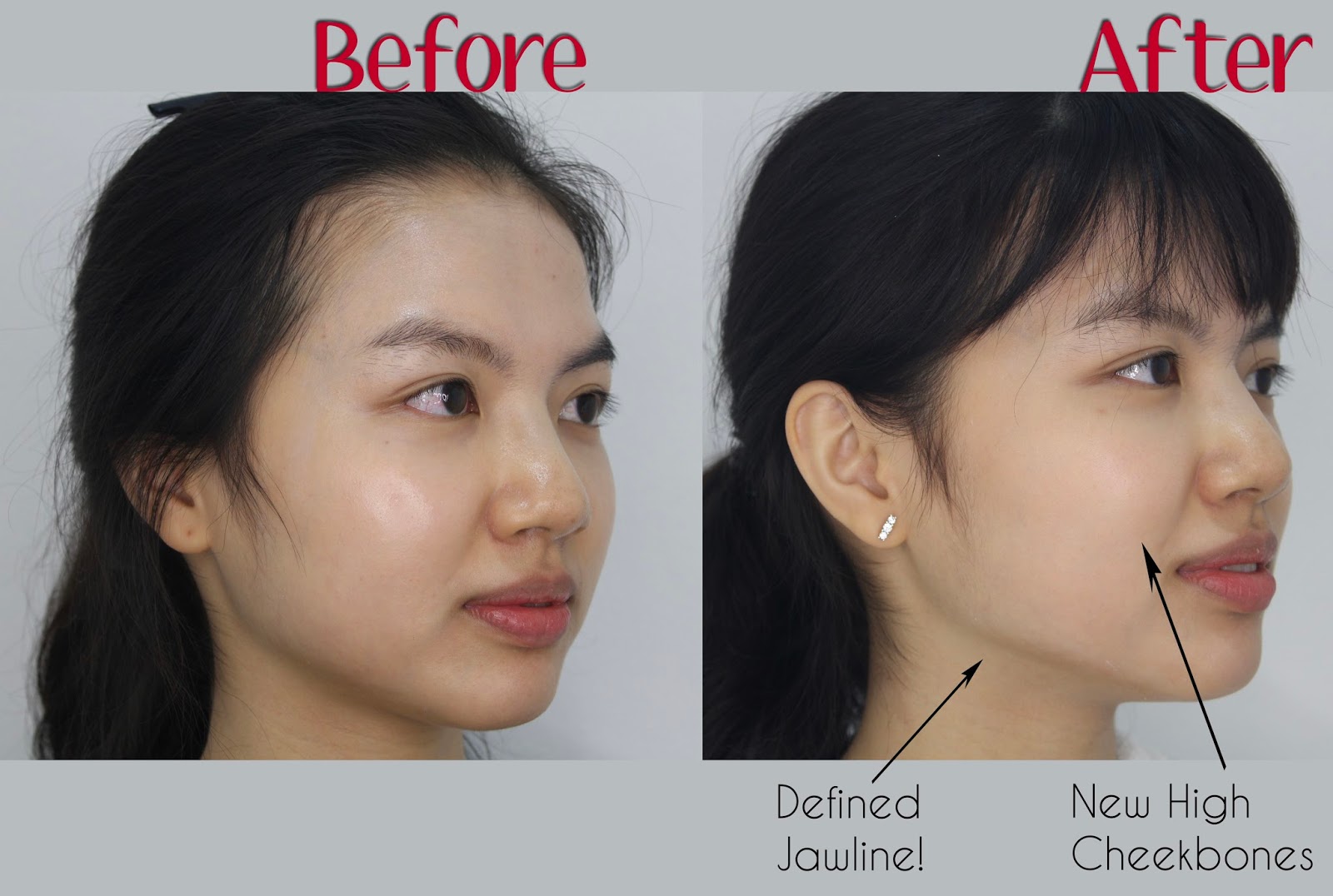 [Review]004 HIFU at Lux Medical Aesthetic Clinic Changing my face shape? Dancing in the skies ♥