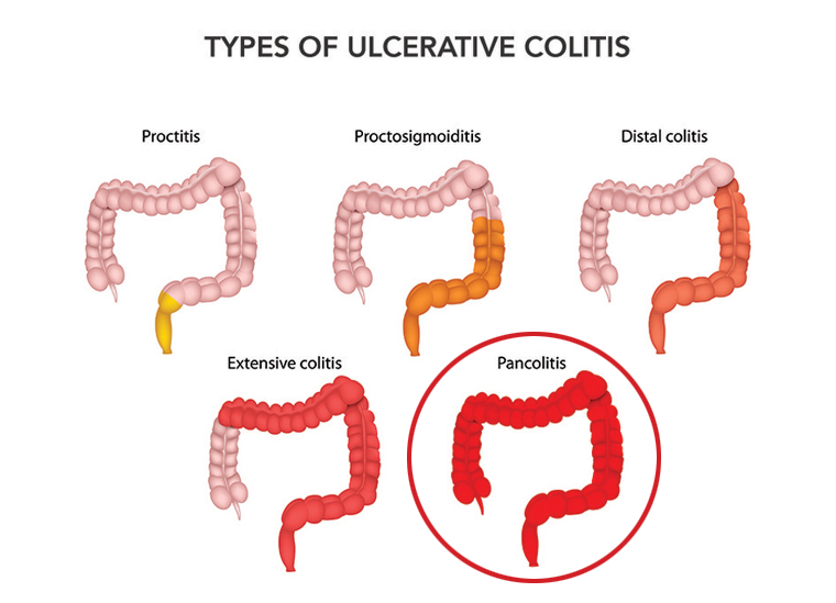 types of ulcerative colitis, ulcerative colitis