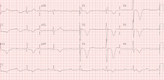Dr. Smith's ECG Blog: Bizarre T-wave inversion of Stokes Adams attack ...