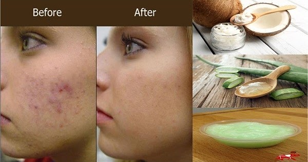 PUT THIS ALOE VERA AND COCONUT OIL FACE MASK TWICE A WEEK