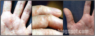 Disidrose nos pés - eczema disidrotico