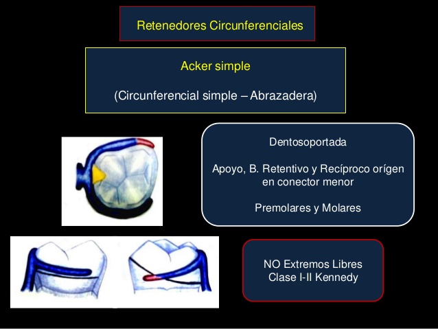 Prótesis Parcial Removible (PPR)