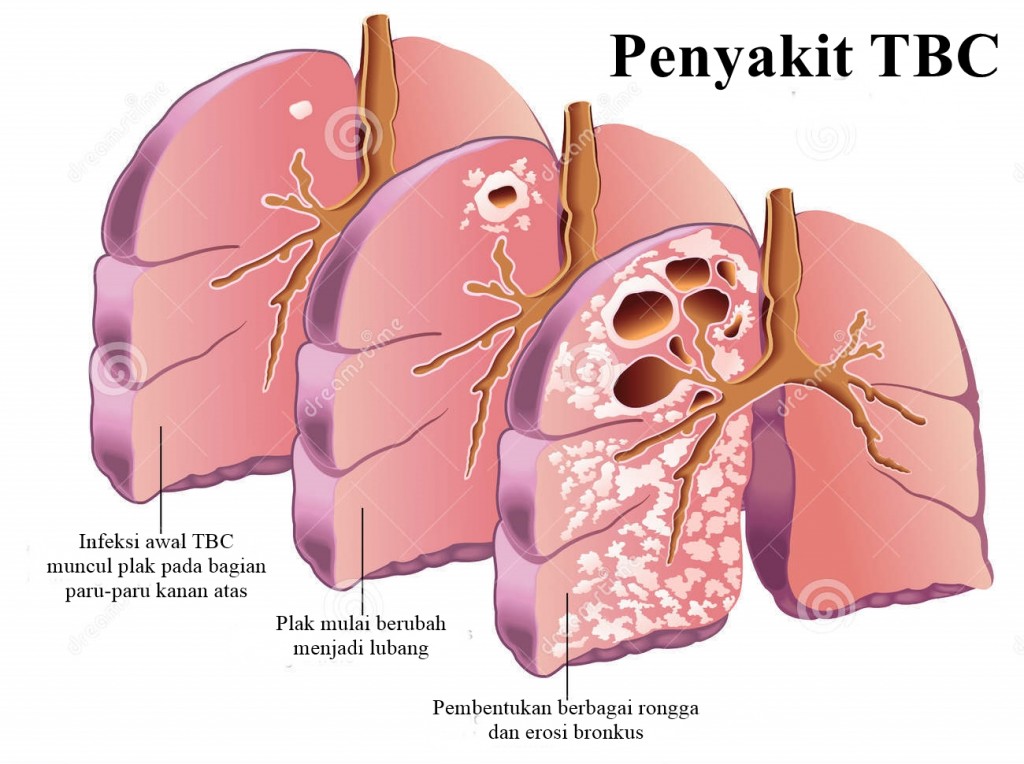 Gangguan, Kelainan, dan Penyakit Pada Sistem Pernapasan Manusia | VRACARSA