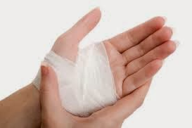 Ilustrasi Tangan Terkilir Bengkak