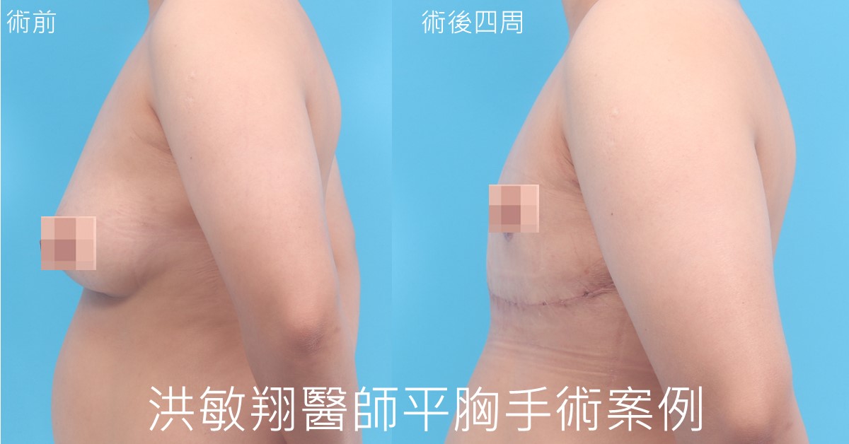 洪敏翔醫師一字型平胸手術 一字型平胸手術案例側面