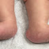 Rocker bottom feet Pictures, Trisomy, Symptoms, Causes, Treatment