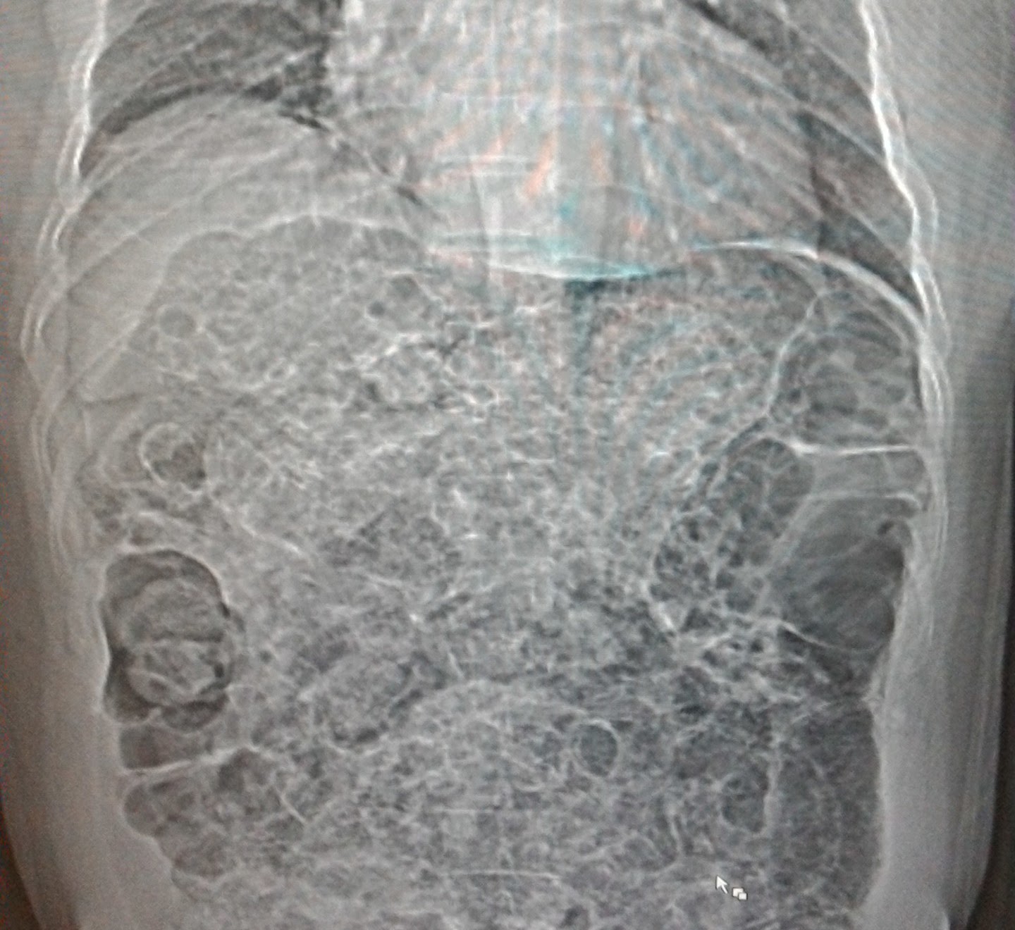 Air bubbles everywhere in the abdomen