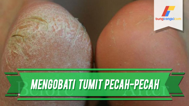 Cara Menghilangkan dan Mengobati Tumit yang Pecah-pecah Cara Menghilangkan dan Mengobati Tumit yang Pecah-pecah