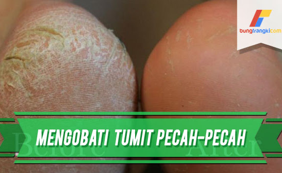 Cara Menghilangkan dan Mengobati Tumit yang Pecah-pecah