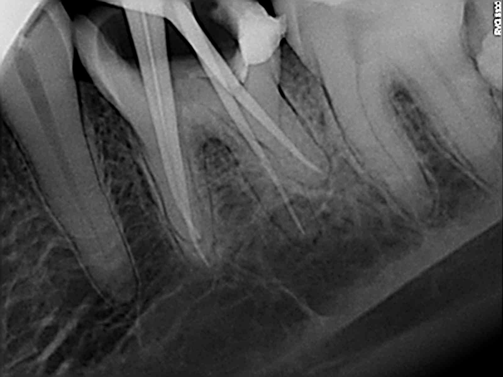 DENTAL TALKS Post Operative Instructions After a Root Canal Treatment