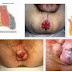 Obat Untuk Bab Berlendir Dan Berdarah Pada Orang Anak thumbnail