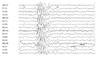 aura definition epilepsy aura definition epilepsy