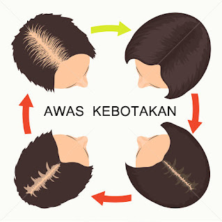 solusi kebotakan penumbuh rambut botak cepat solusi kebotakan penumbuh rambut botak cepat